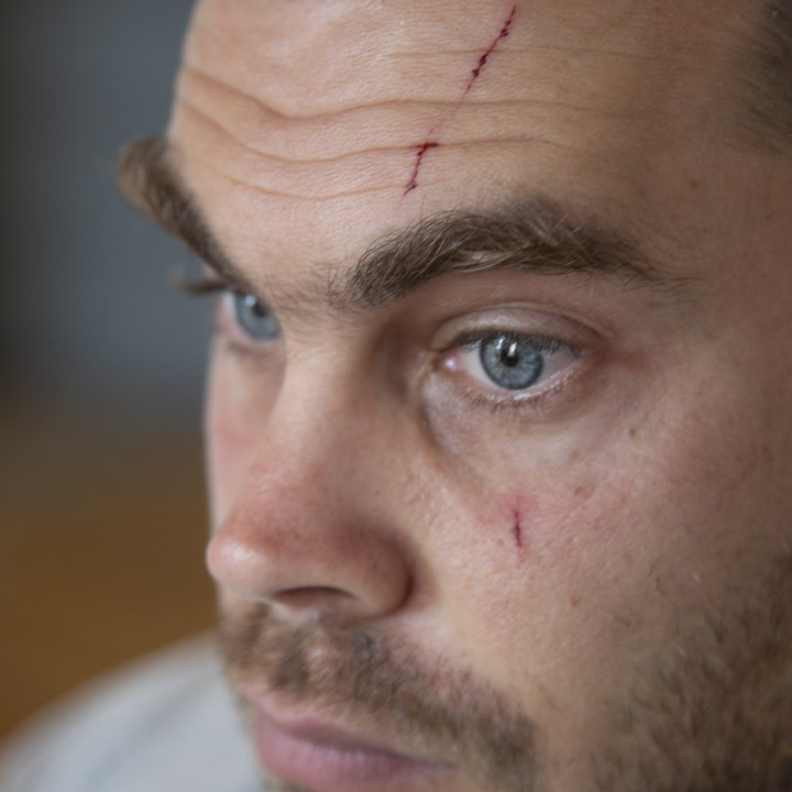 חתכים בפניו של יונתן פולק שהותקף בתל אביב על ידי שני גברים אלמונים. פולק הוא פעיל מוכר נגד הכיבוש (היידי מוטולה / אקטיבסטילס)